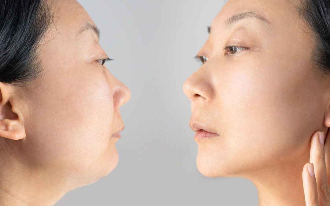 Minimize A Double Chin with Kybella