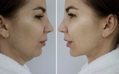 Remove Your Double Chin with Kybella