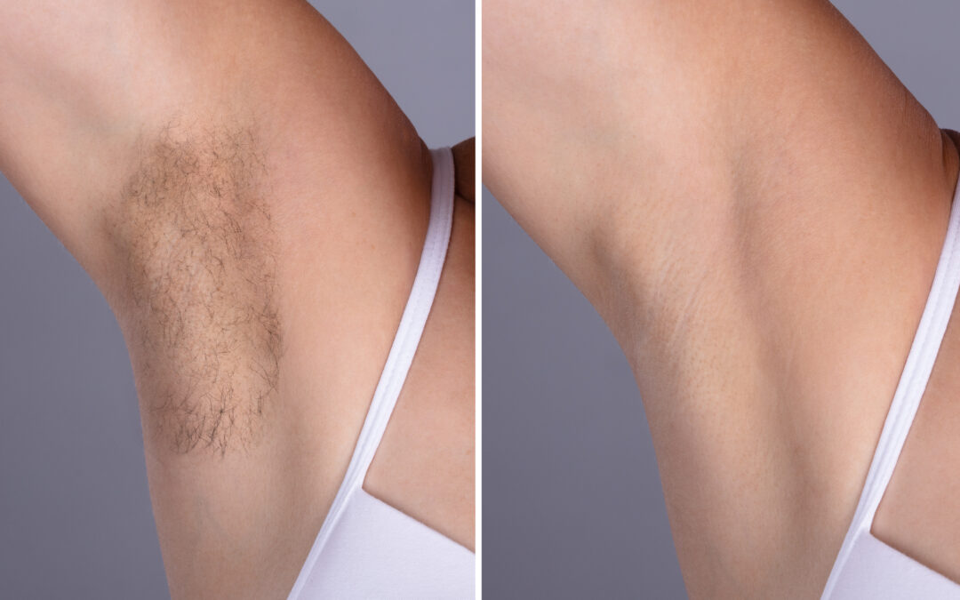 Benefits of Starting Laser Hair Removal in the Fall
