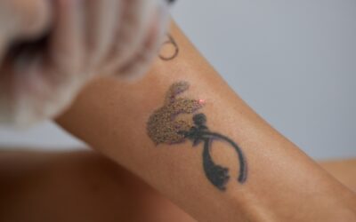 Ultimate Guide To Laser Tattoo Removal