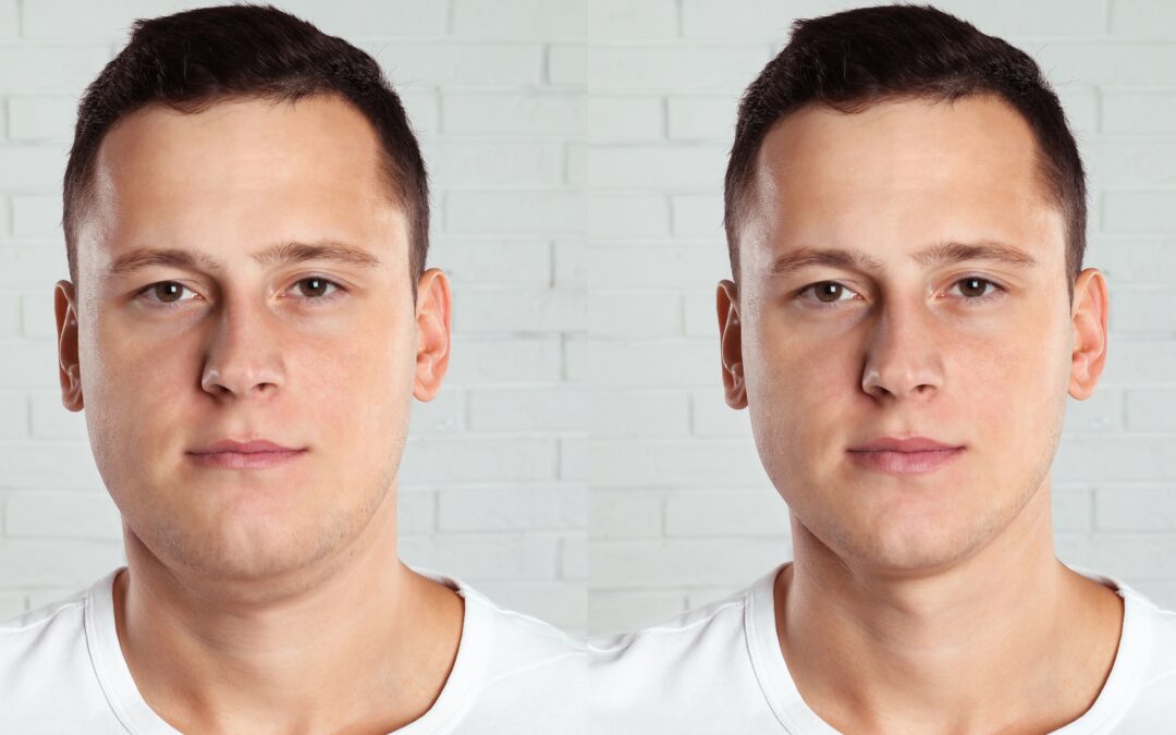 Using Kybella to Treat a Double Chin