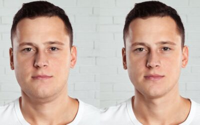 Using Kybella to Treat a Double Chin