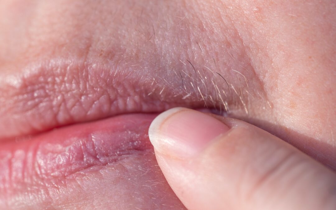 Tackle Your Mustache with Laser Hair Removal in Oklahoma City