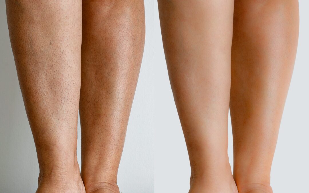 Considering Laser Hair Removal in Oklahoma City?