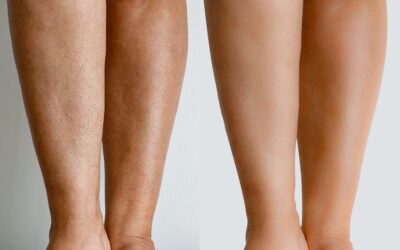 Considering Laser Hair Removal in Oklahoma City?