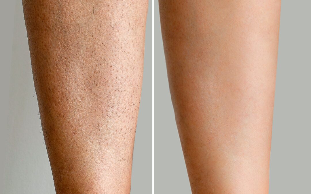 5 Great Reasons You Should Consider Laser Hair Removal in OKC