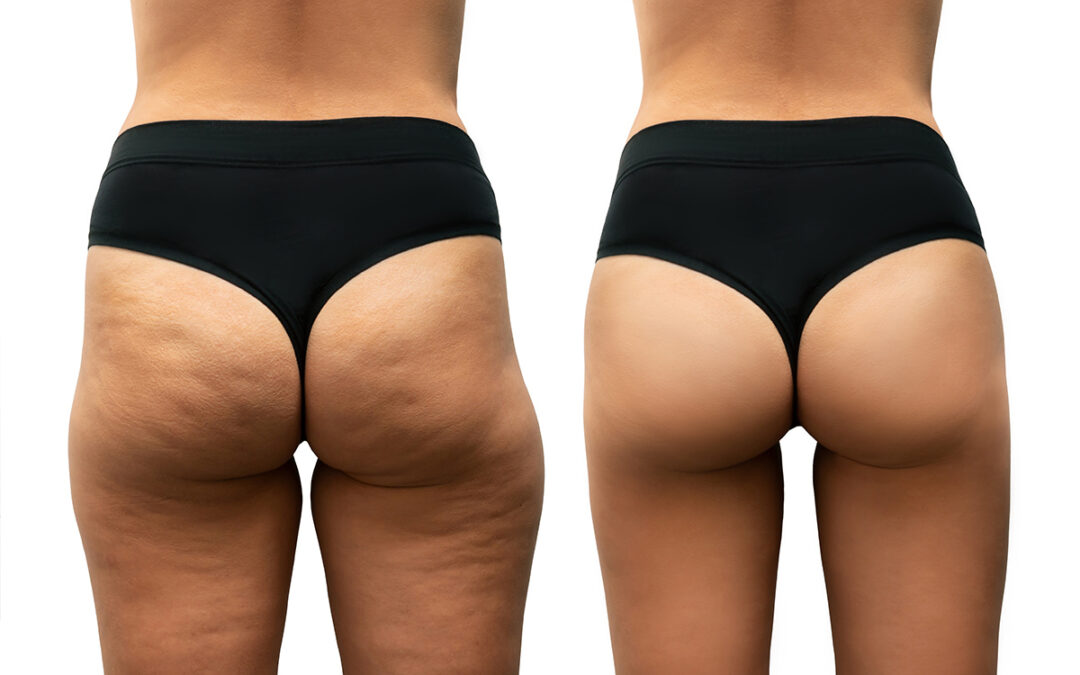 Reduce Your Body Fat in Less than One Hour with CoolSculpting