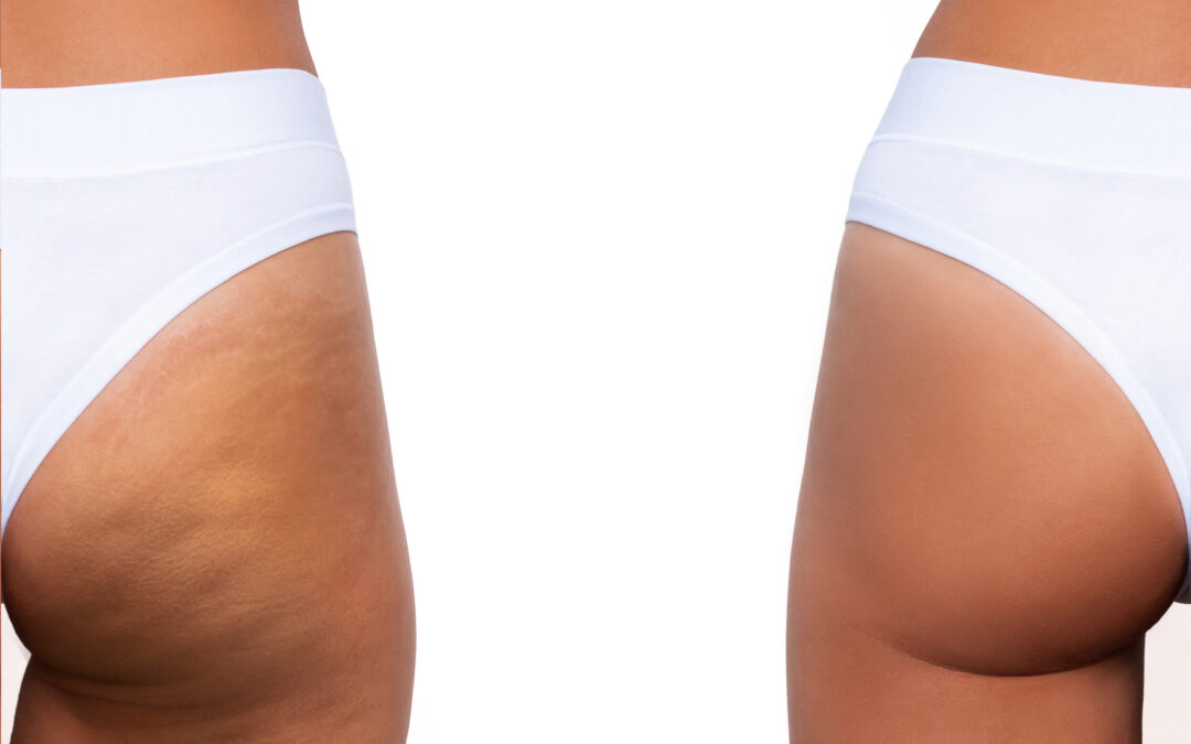 Wave Goodbye to Imperfections: ZWave Contouring